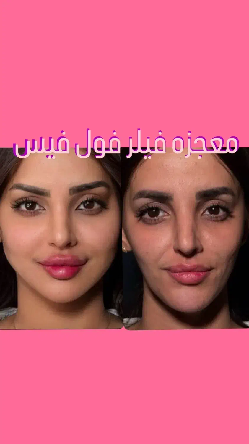 بوتاکس پیشانی،خط اخم  رایگان شد توسط پزشک|خدمات آرایشگری و زیبایی|کاشان, بهشتی|دیوار