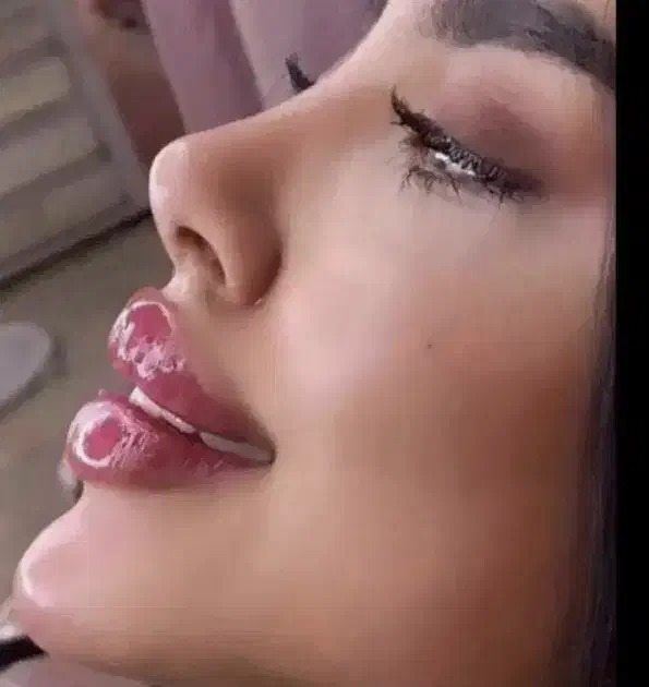 مزونیدلینگ ژل و بوتاکس|خدمات آرایشگری و زیبایی|یاسوج, |دیوار