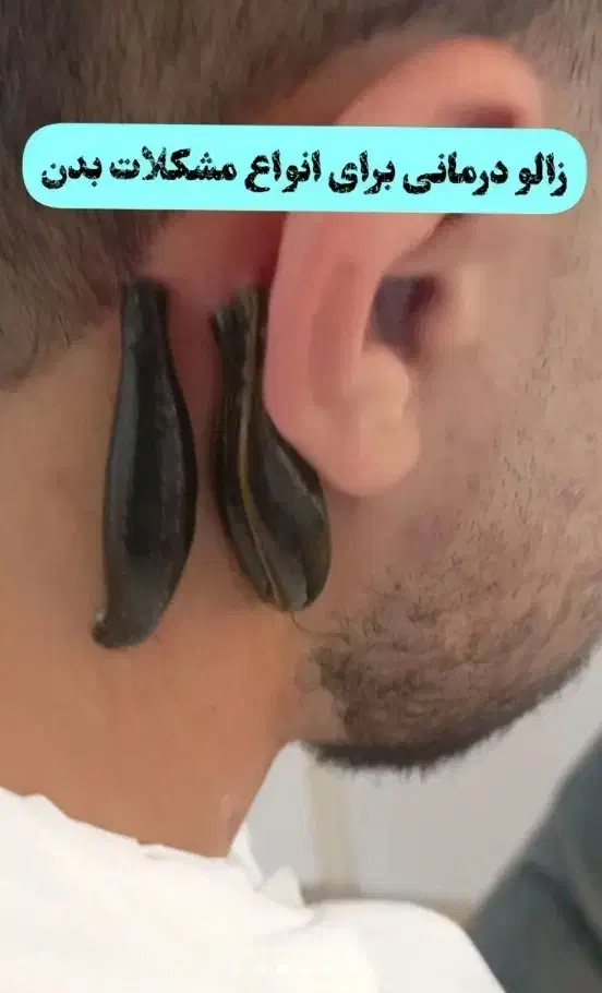 زالو فصد حجامت طب سوزنی طب سنتی بادکش گرم و سرد|خدمات آرایشگری و زیبایی|اصفهان, طامه|دیوار