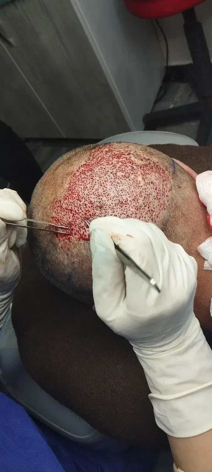 کاشت مو و ابرو|خدمات آرایشگری و زیبایی|سراب, |دیوار