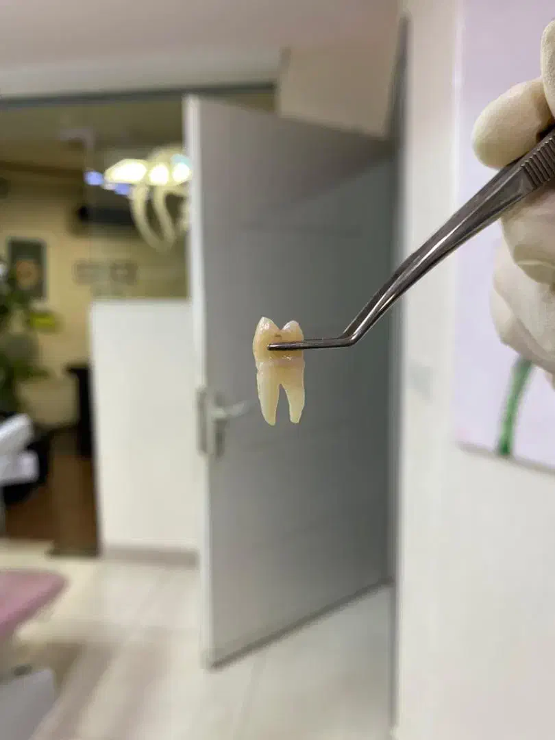 فروش دندان های خلفی4.5سالم|پزشکی|رشت, سعدی (تختی)|دیوار