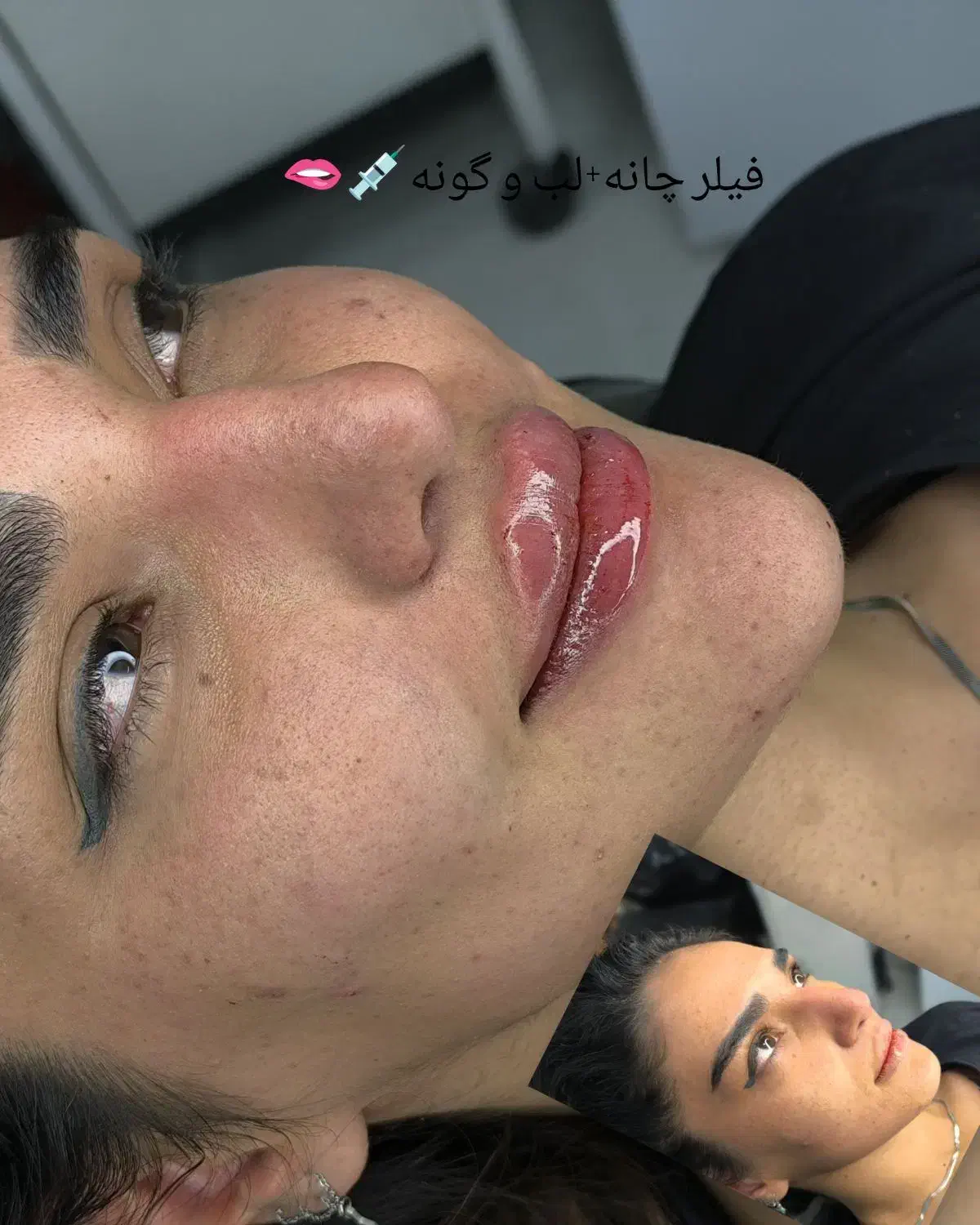 ژل وبوتاکس|خدمات آرایشگری و زیبایی|ایذه, |دیوار