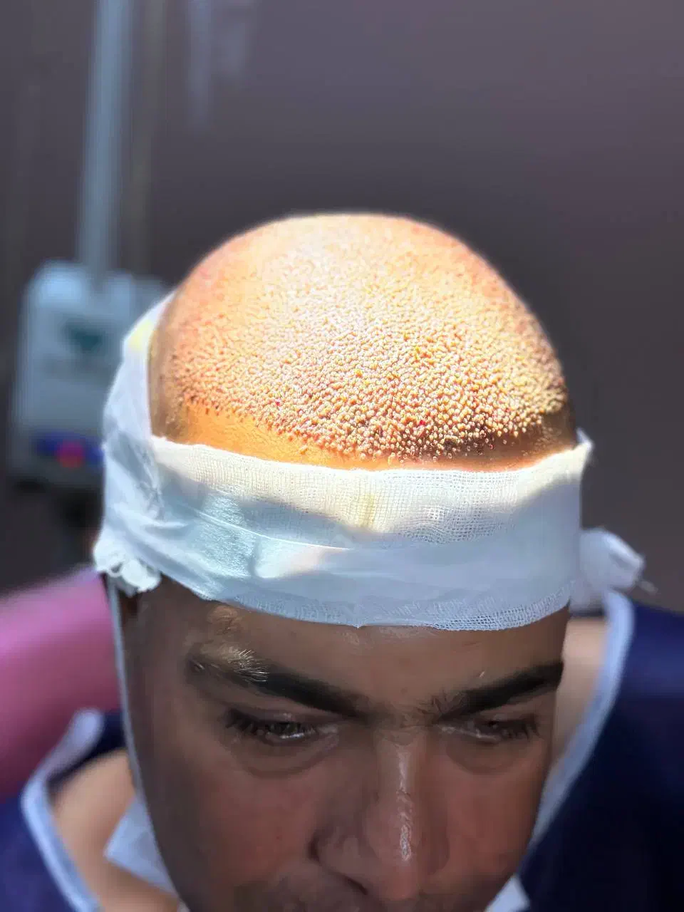 کاشت مو پر تراکم|خدمات آرایشگری و زیبایی|جهرم, |دیوار