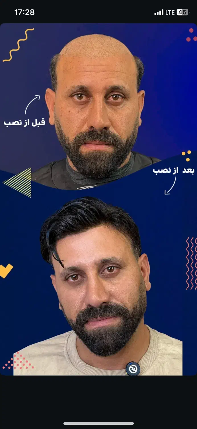 کاشت مو‌بدون جراحی  (پروتز مو‌بدون‌چسب)|خدمات آرایشگری و زیبایی|درگهان, |دیوار