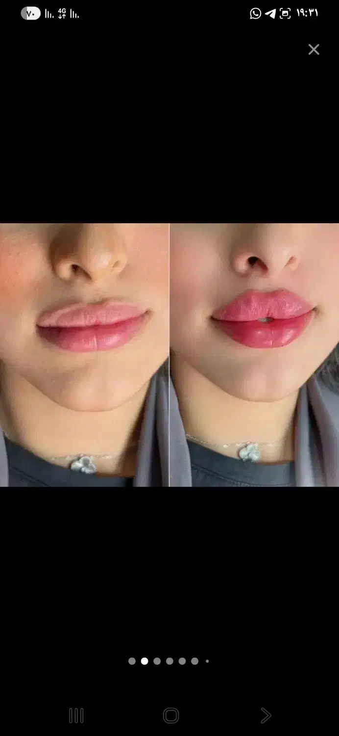 جشنواره تخفیف بوتاکس|خدمات آرایشگری و زیبایی|قم, صفاشهر|دیوار