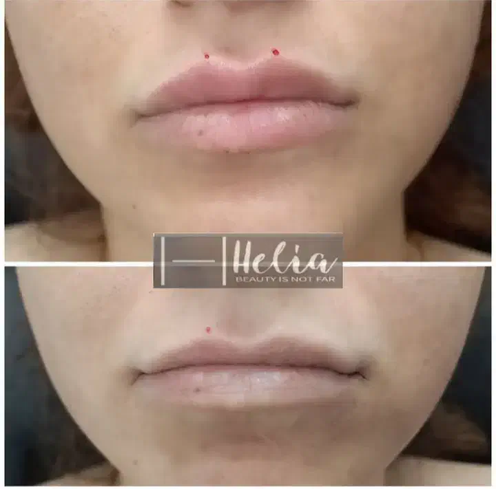 تزریق تخصصی فیلر|خدمات آرایشگری و زیبایی|شیراز, تندگویان|دیوار