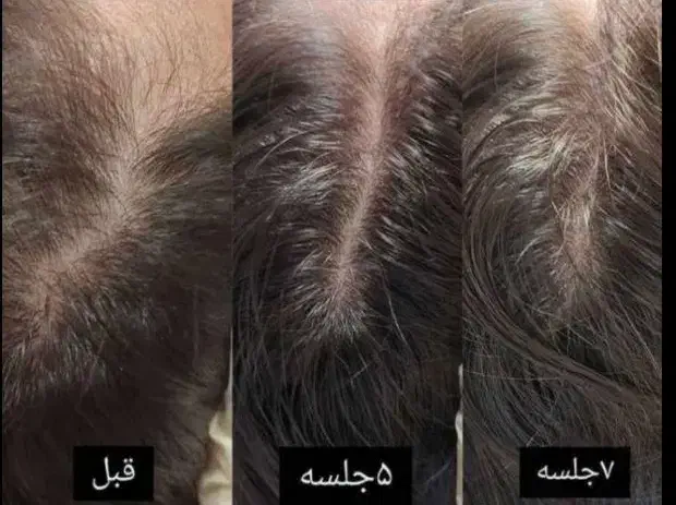 کلینیک تخصصی  خدمات زیبایی(ژل و بوتاکس ) با تخفیف|خدمات آرایشگری و زیبایی|کاشان, فین کوچک|دیوار