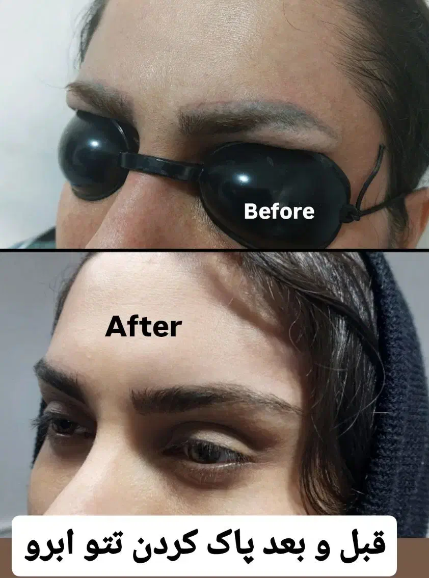 لیزرتتوابرو،لیزرهالیوودی کیوسوئیچ|خدمات آرایشگری و زیبایی|بروجرد, |دیوار