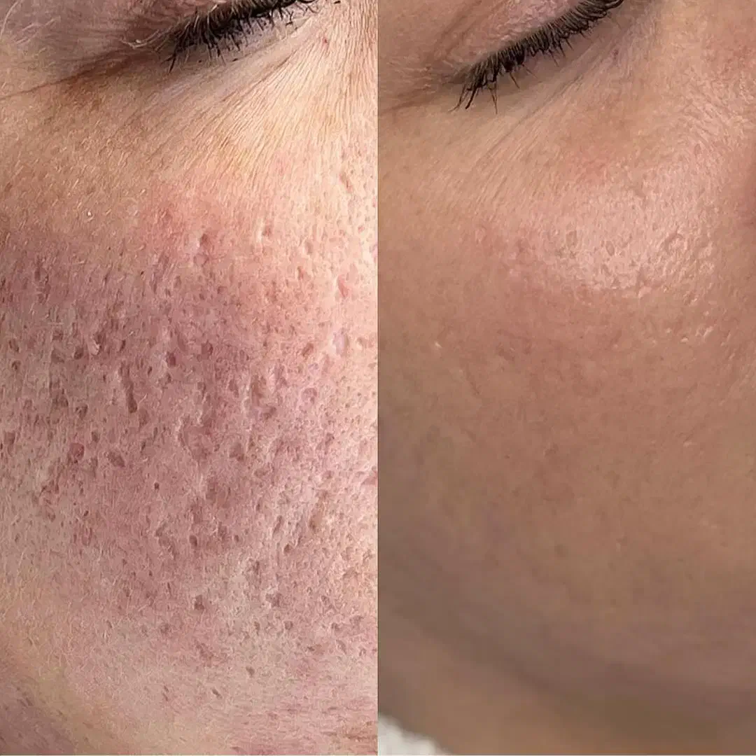 من اسکار،ولک پوستتو درمان میکنم بدون سوزن ودرد|خدمات آرایشگری و زیبایی|کاشان, دشت چال|دیوار