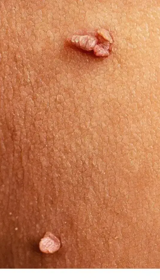 درمان تخصصی خال و زگیل|خدمات آرایشگری و زیبایی|سنندج, |دیوار