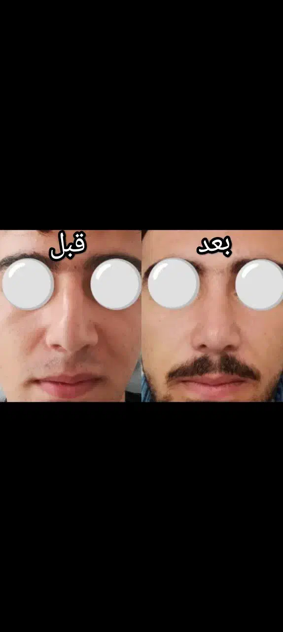 عمل زیبایی بینی|خدمات آرایشگری و زیبایی|زنجان, |دیوار