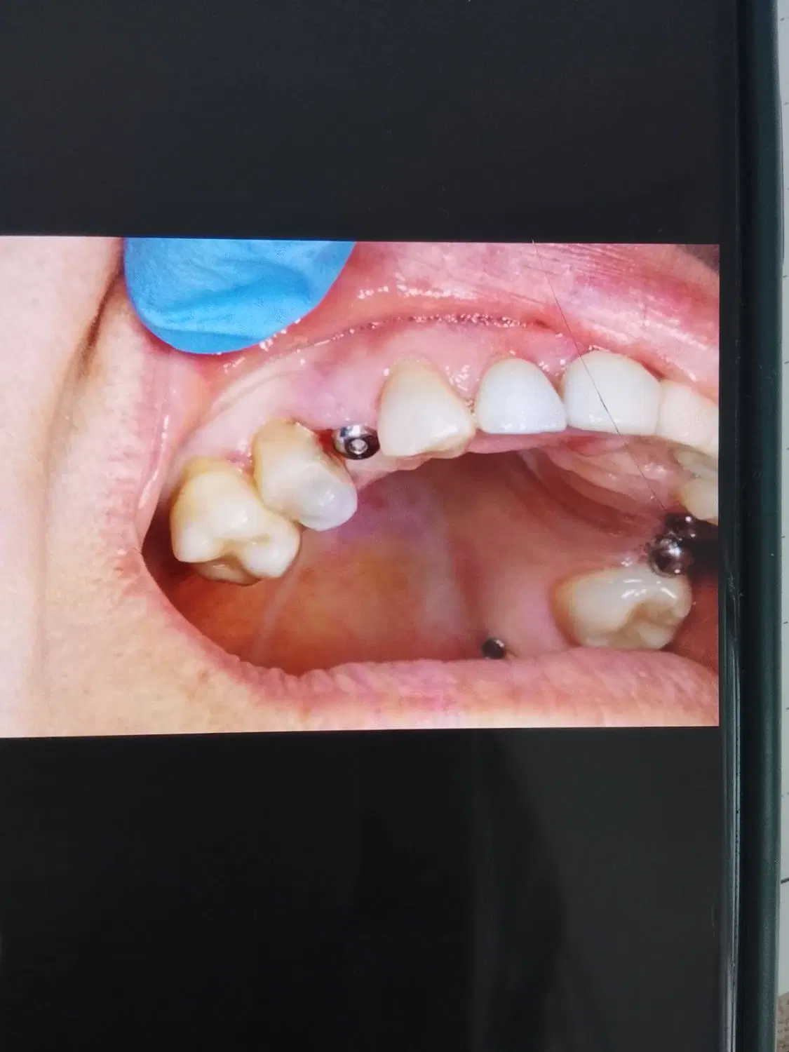 مرکزفوق تخصصی ایمپلنت دیجیتال/سبک کاخ لبخند/یکروزه|خدمات زیبایی و سلامت|مشهد, احمدآباد|دیوار