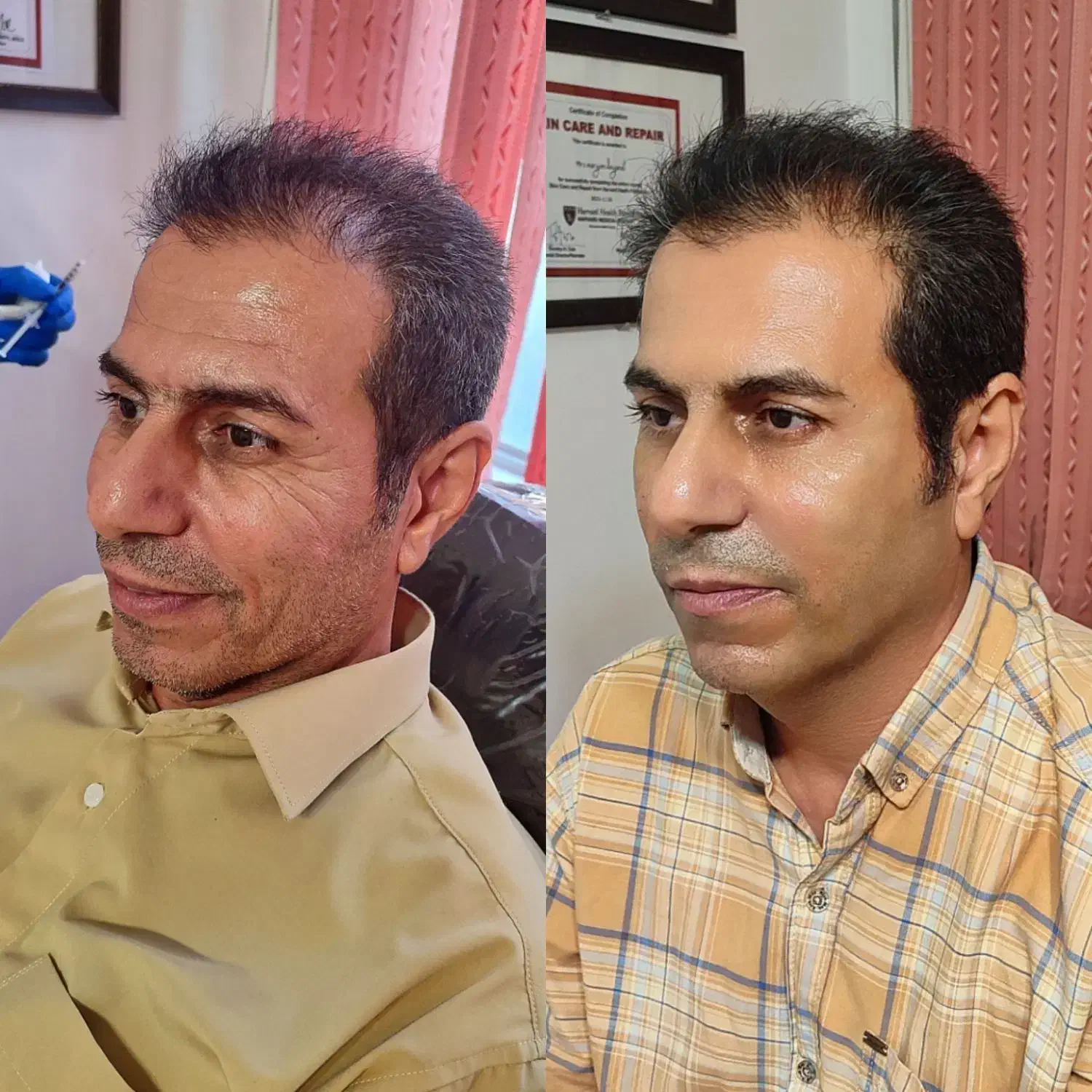 ژل بوتاکس فیلر آنزیم خالبرداری با تخفیف ویژه|خدمات آرایشگری و زیبایی|تهران, سبلان (لشگر)|دیوار