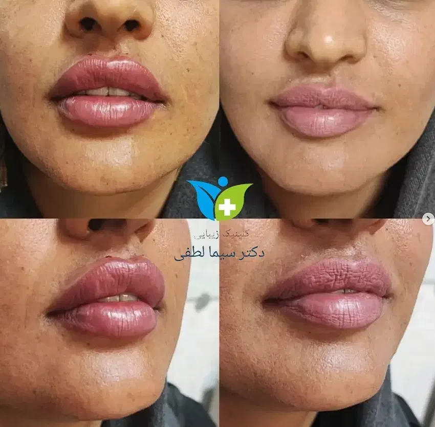 تزریق ژل بوتاکس جوانسازی پی آر پی کربوکسی و لاغری|خدمات آرایشگری و زیبایی|قزوین, |دیوار