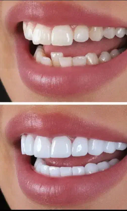 کامپوزیت دندان با متریال با کیفیت و قیمت مناسب|خدمات آرایشگری و زیبایی|ایذه, |دیوار