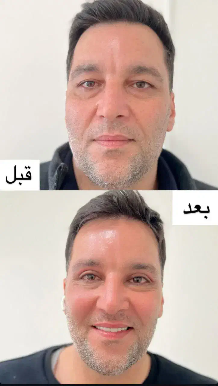 جشنواره پاییزه جراحی زیبایی پلک(بلفاروپلاستی)|خدمات آرایشگری و زیبایی|تهران, قیطریه|دیوار