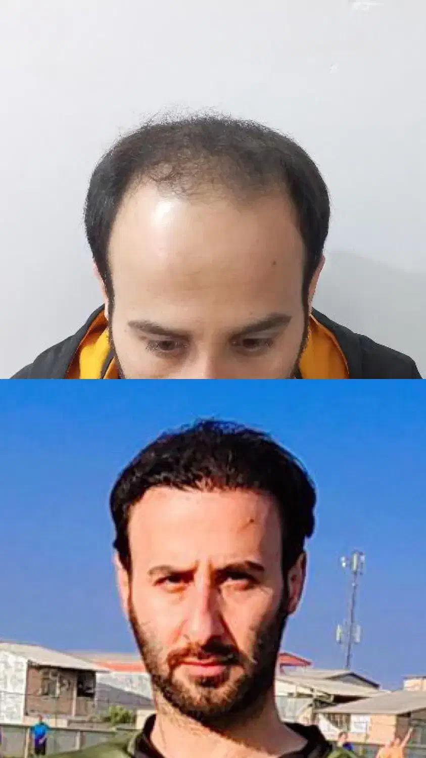 کاشت مو فول تراکم تضمینی|خدمات آرایشگری و زیبایی|گرگان, |دیوار