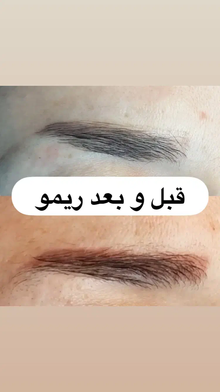 ریمو تتوی صورت(فقط بانوان)|خدمات آرایشگری و زیبایی|قم, کیوانفر|دیوار