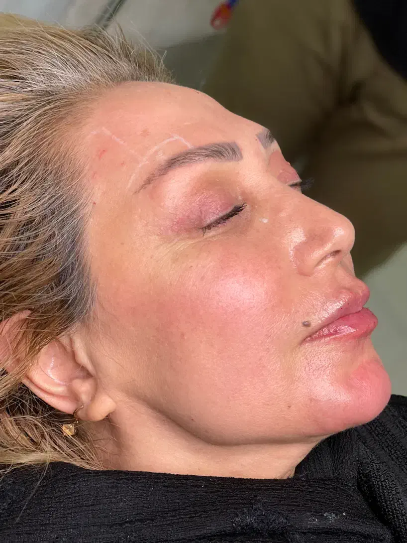 تزریق ژل و بوتاکس|خدمات آرایشگری و زیبایی|ارومیه, |دیوار