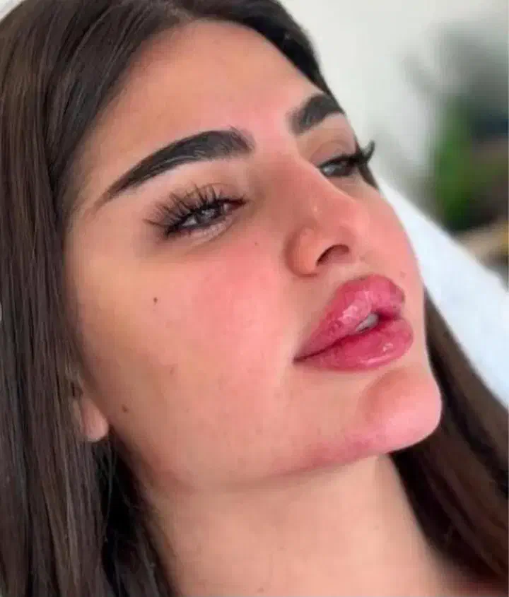 تزریق ژل و بوتاکس بدون درد و کبودی|خدمات آرایشگری و زیبایی|بروجن, |دیوار