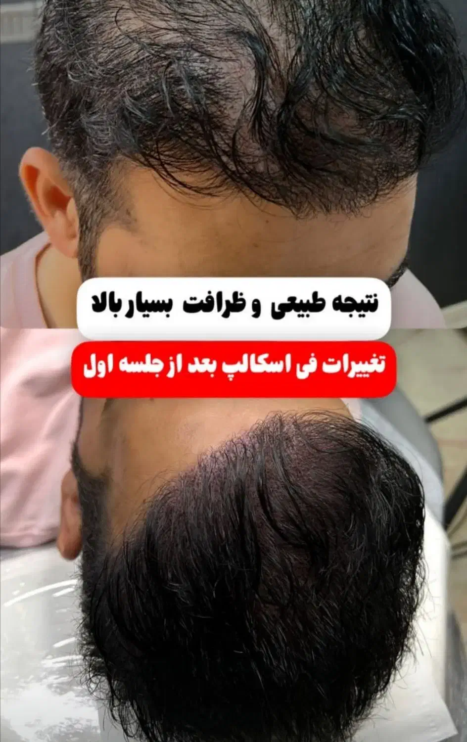 میکرواسکالپ فی اسکالپ سر|خدمات آرایشگری و زیبایی|شیراز, ملاصدرا|دیوار