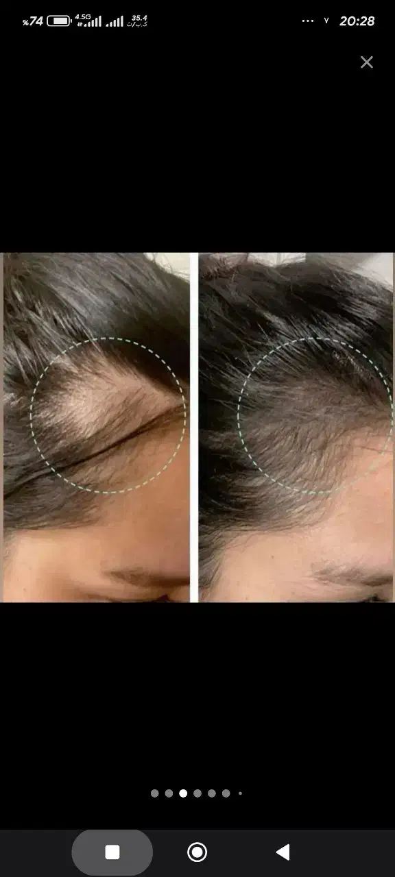 راه نجات کم‌پشتی مو با میکرواسکالپ|خدمات آرایشگری و زیبایی|دزفول, |دیوار