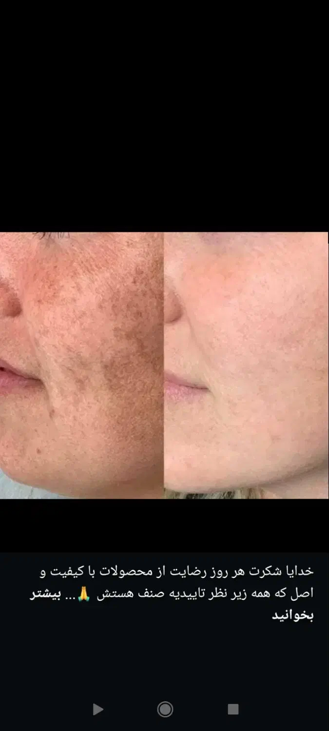 کرم ضدلک گیاهی ژل رویال|آرایشی، بهداشتی، درمانی|اسدآباد, |دیوار