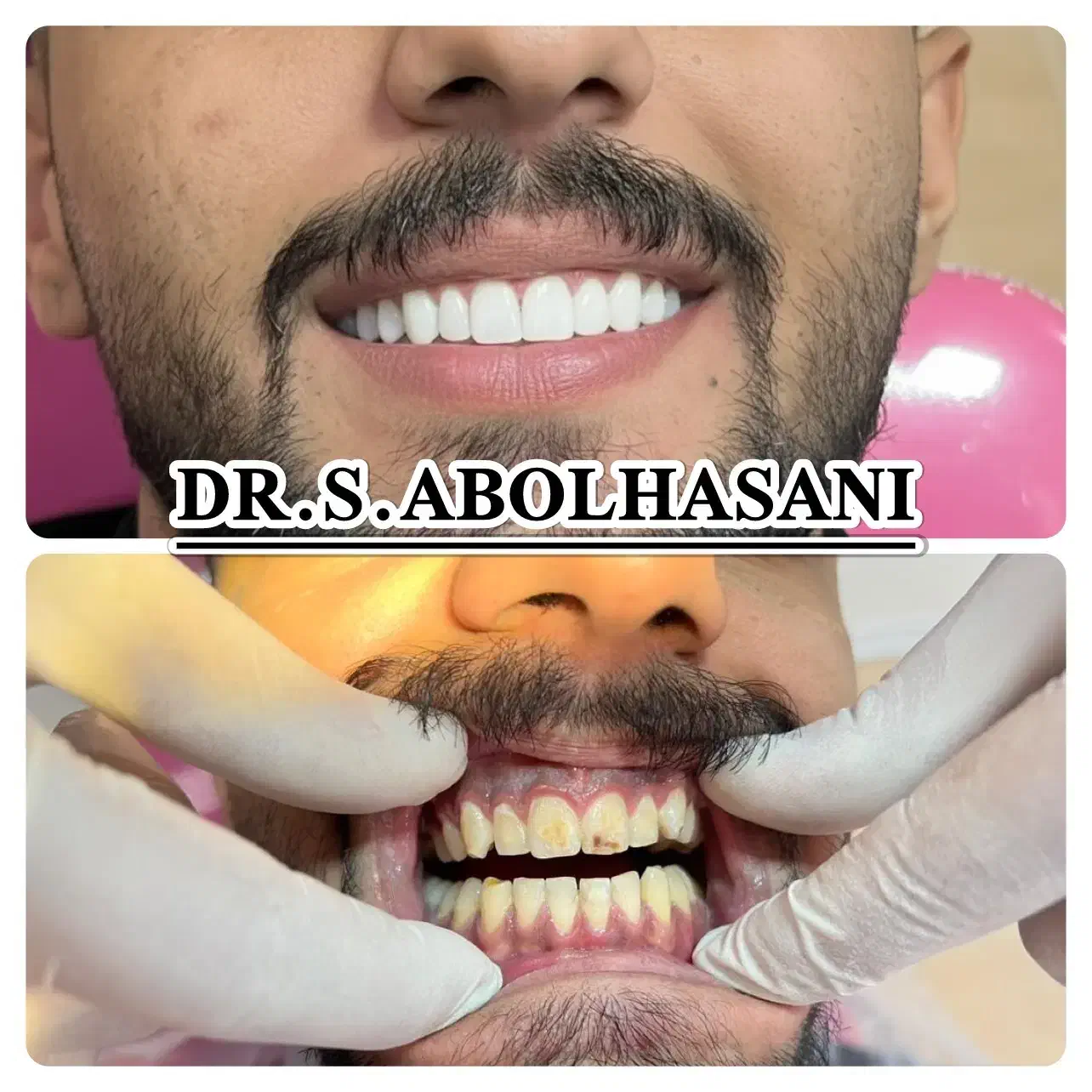 لمینت لیرینگ  ده تومن پیش پرداخت اصفهان|خدمات آرایشگری و زیبایی|شهرضا, |دیوار