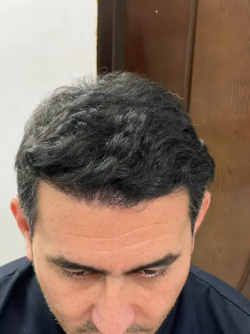 کاشت مو تخصصی|خدمات آرایشگری و زیبایی|تبریز, |دیوار