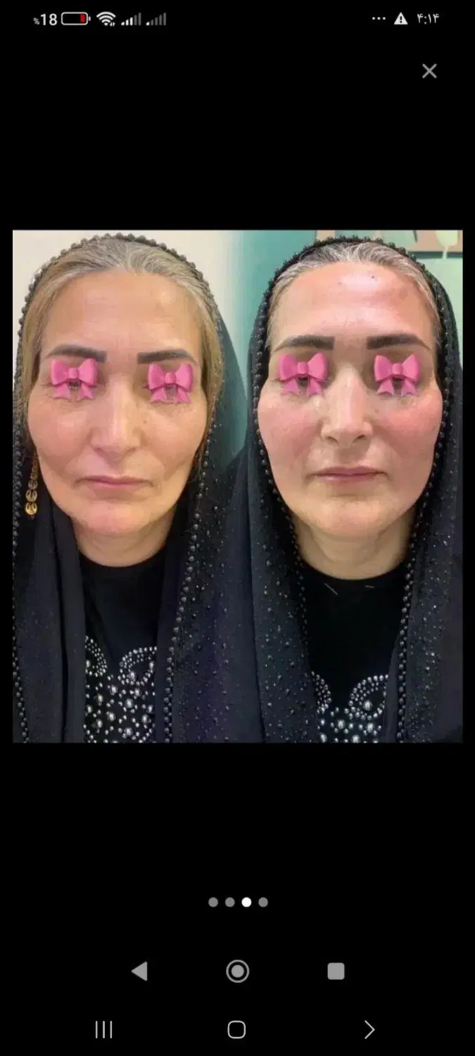 فیلر|خدمات آرایشگری و زیبایی|زاهدان, |دیوار