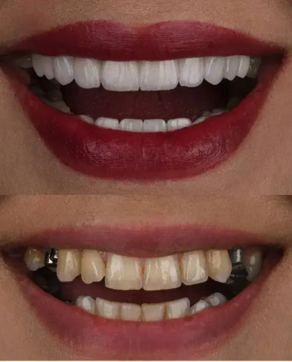 دندانپزشکی و شرایط اقساطی بدون بهره ایمپلنت|خدمات آرایشگری و زیبایی|تبریز, |دیوار