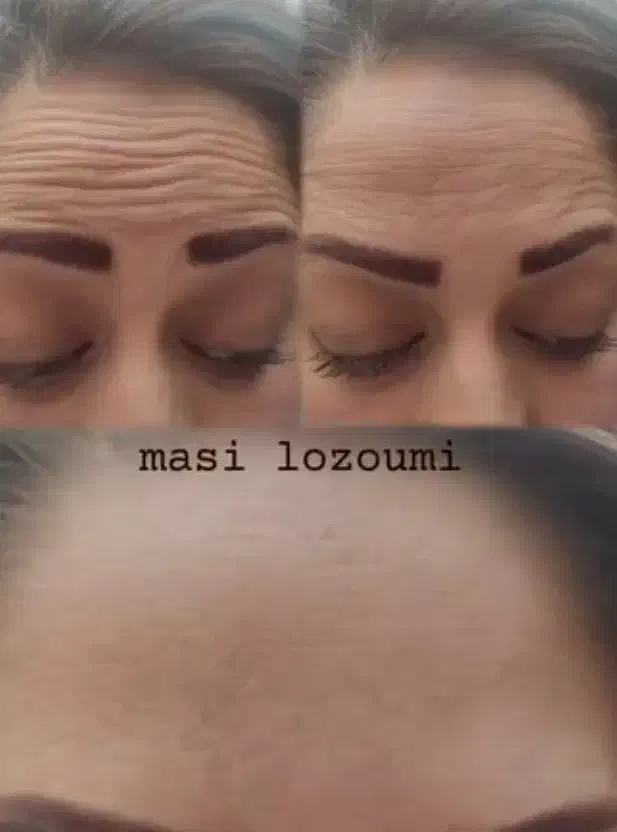 مرکز تخصصی ژل و بوتاکس در قزوین|خدمات آرایشگری و زیبایی|قزوین, |دیوار