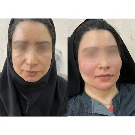 آموزش تخصصی و درمانی ژل و بوتاکس|خدمات آموزشی|اصفهان, مهدی آباد|دیوار