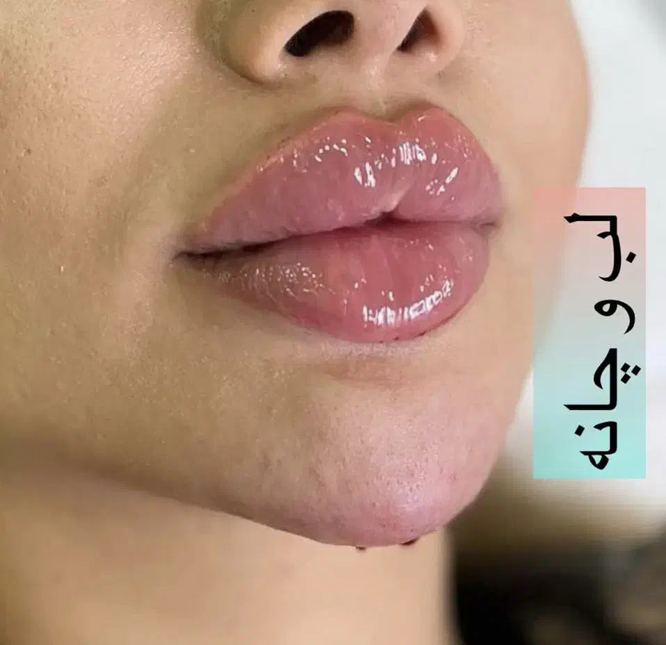 ژل و بوتاکس|خدمات آرایشگری و زیبایی|تاکستان, |دیوار