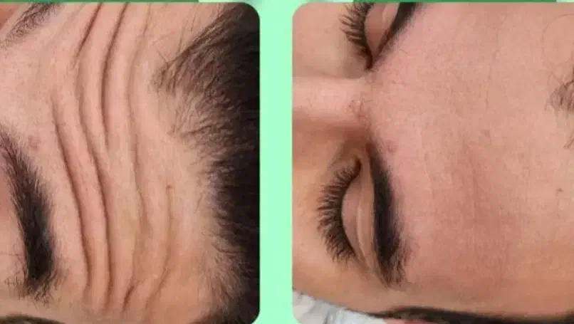 هایفو بوتاکس ژل لب زاویه سازی فیلر بادی هیپ سینه|خدمات آرایشگری و زیبایی|تهران, نارمک|دیوار