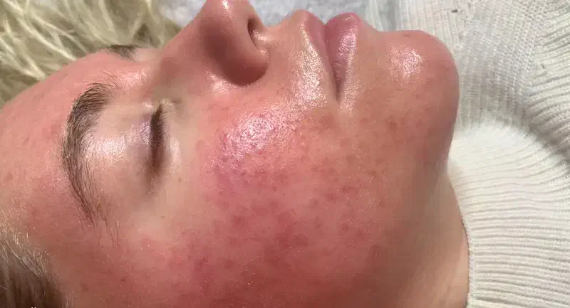 میکرونیدلینگ مزونیدلینگ مزوتراپی در منزل|خدمات آرایشگری و زیبایی|تهران, اختیاریه|دیوار