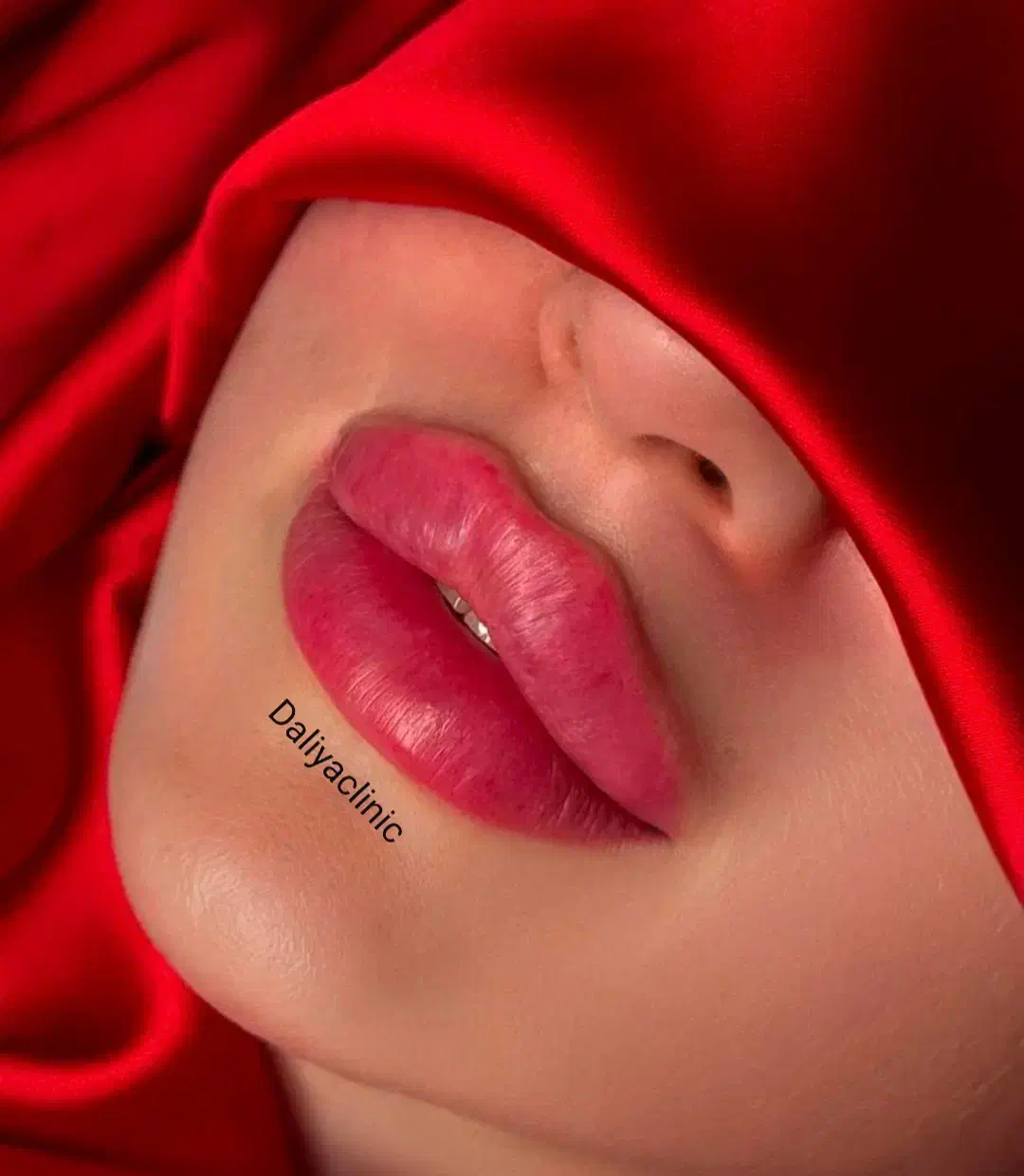 تزریق ژل (فیلر)و بوتاکس و لیفت بانخ ومادلینگ صورت|خدمات آرایشگری و زیبایی|تهران, نارمک|دیوار