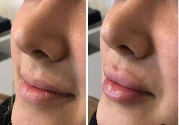 تزریق ژل و بوتاکس تضمینی|خدمات آرایشگری و زیبایی|اهواز, نادری|دیوار