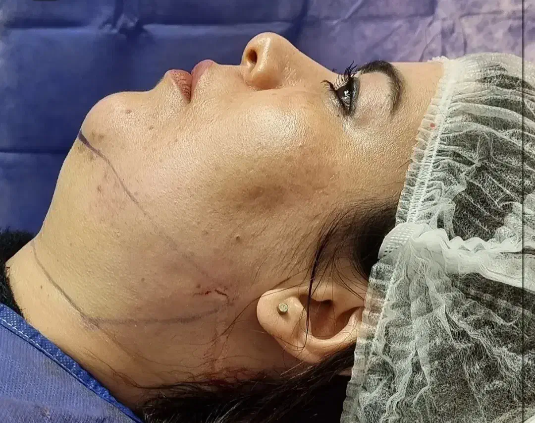 لیپوماتیک آبدو مینو پلاستی پروتز سینه شرایط اقساط|خدمات آرایشگری و زیبایی|تهران, بلوار کشاورز|دیوار
