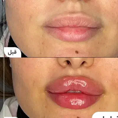 ژل بدن وصورت آموزش  تزریق دراهواز|خدمات آرایشگری و زیبایی|اهواز, کیانپارس |دیوار