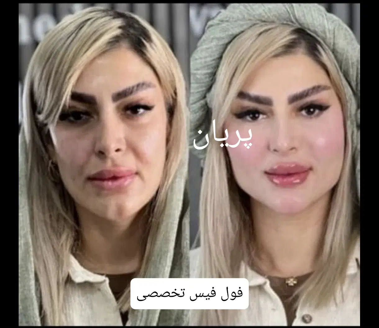 جشنواره فیلر فول فیس ژل بوتاکس نخ هایفو ساکشن|خدمات آرایشگری و زیبایی|مشهد, فرهنگ|دیوار