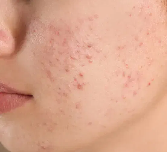 درمان انواع مشکلات پوست و مو|آرایشی، بهداشتی، درمانی|بروجرد, |دیوار