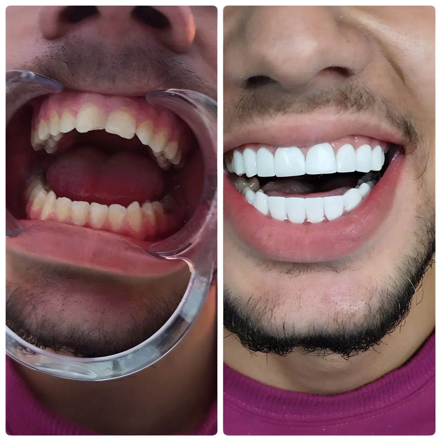 کامپوزیت دندان|خدمات آرایشگری و زیبایی|دورود, |دیوار