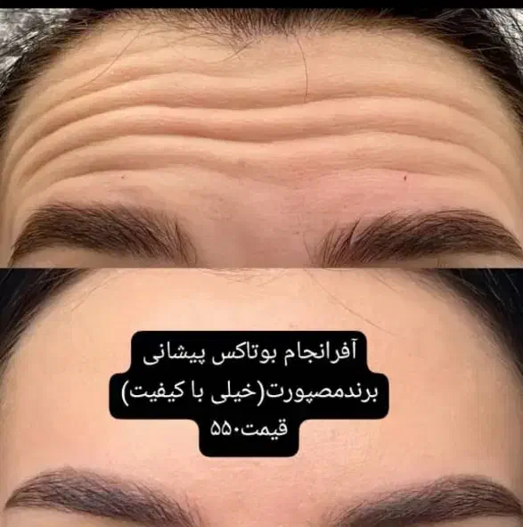 تزریق ژل و بوتاکس|خدمات آرایشگری و زیبایی|دوگنبدان, |دیوار