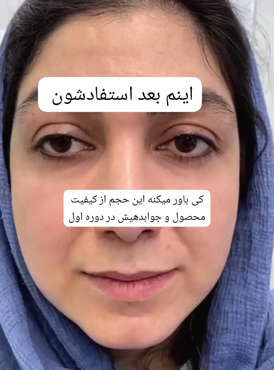 کرم ضد لک تخصصی|آرایشی، بهداشتی، درمانی|ایرانشهر, |دیوار