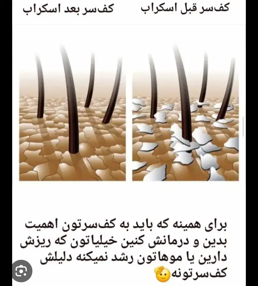 افر ویژه خدمات اسکراب کف سر-درمانی ۲.۵۰۰ تومان|خدمات آرایشگری و زیبایی|کیش, |دیوار