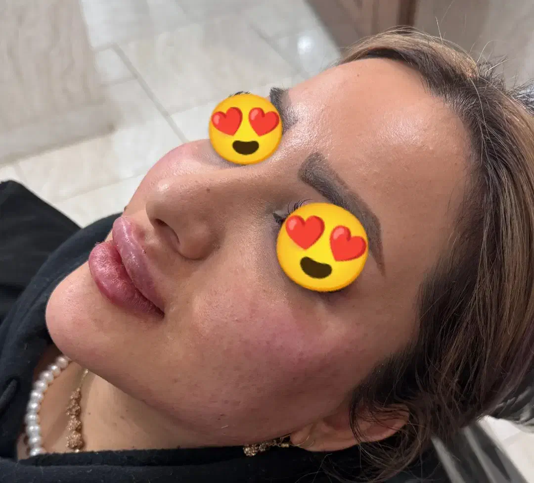 ژل و بوتاکس مزوتراپی و مزونیدلینگ آرایش دایم|خدمات آرایشگری و زیبایی|اردکان, |دیوار