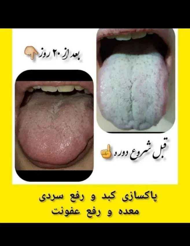 درمان و پاکسازی کبد|آرایشی، بهداشتی، درمانی|گنبد کاووس, |دیوار