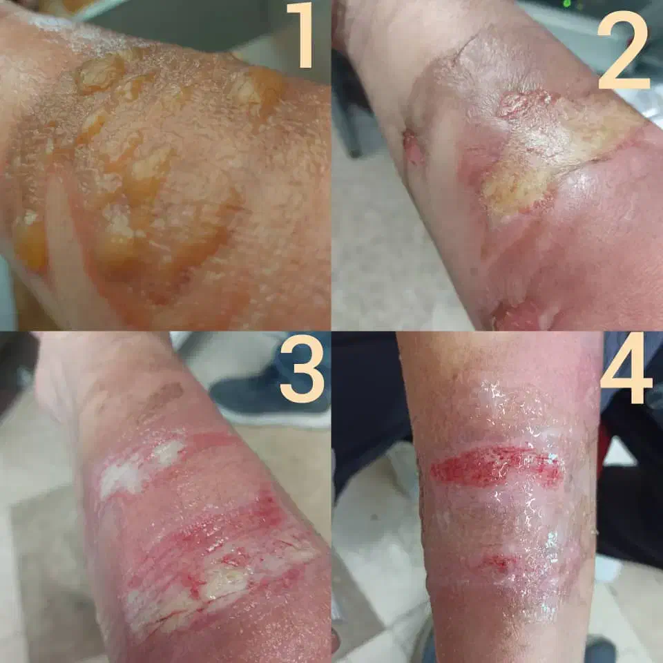 درمان تضمینی و تخصصی زخم در منزل|خدمات آرایشگری و زیبایی|تهران, نظامی گنجوی (توانیر)|دیوار