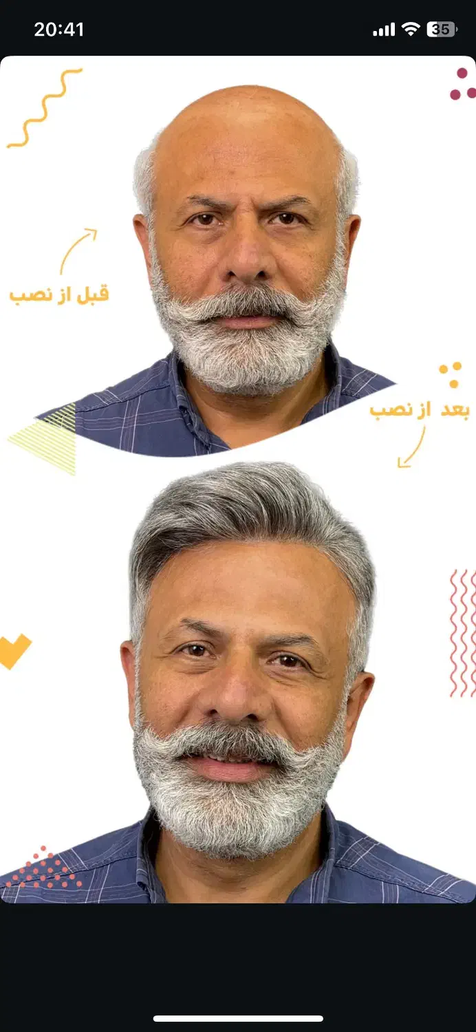 کاشت مو‌بدون جراحی  (پروتز مو‌بدون‌چسب)|خدمات آرایشگری و زیبایی|درگهان, |دیوار